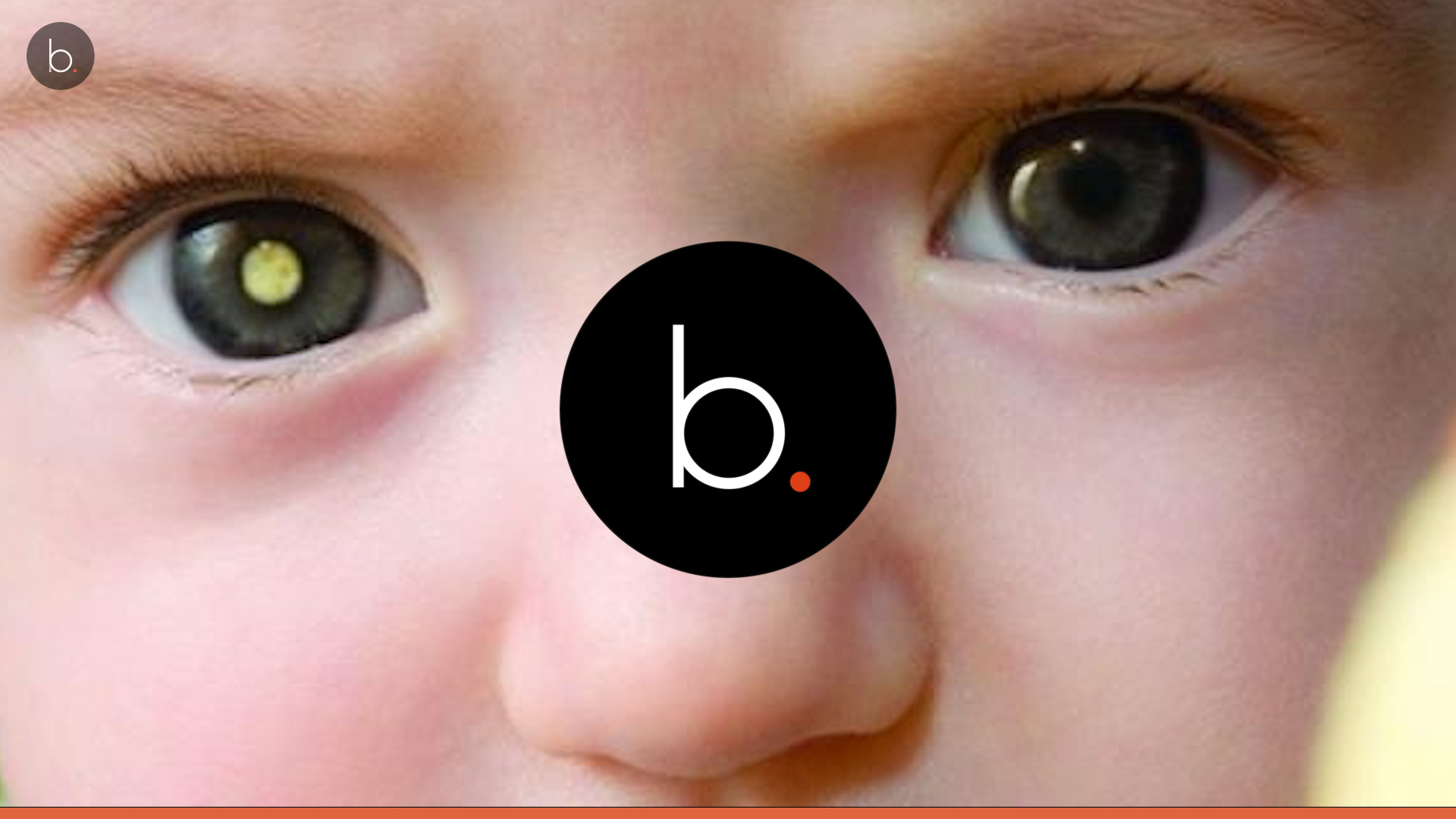 Bebê vence câncer raro com quimioterapia após quase perde olho