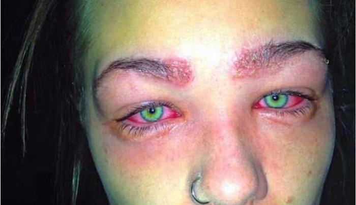Assista: Jovem de 16 anos quase perdeu a visão por causa de um produto; confira
