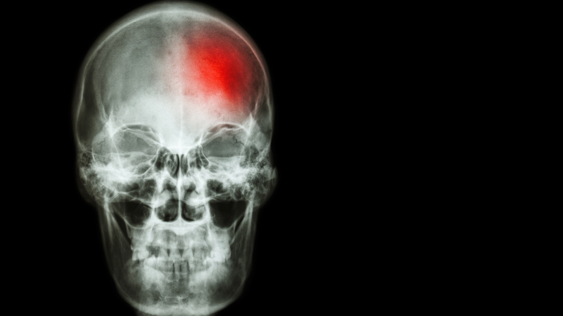 "Marcapasos" cerebral para Alzheimer muestra una promesa de disminución gradual