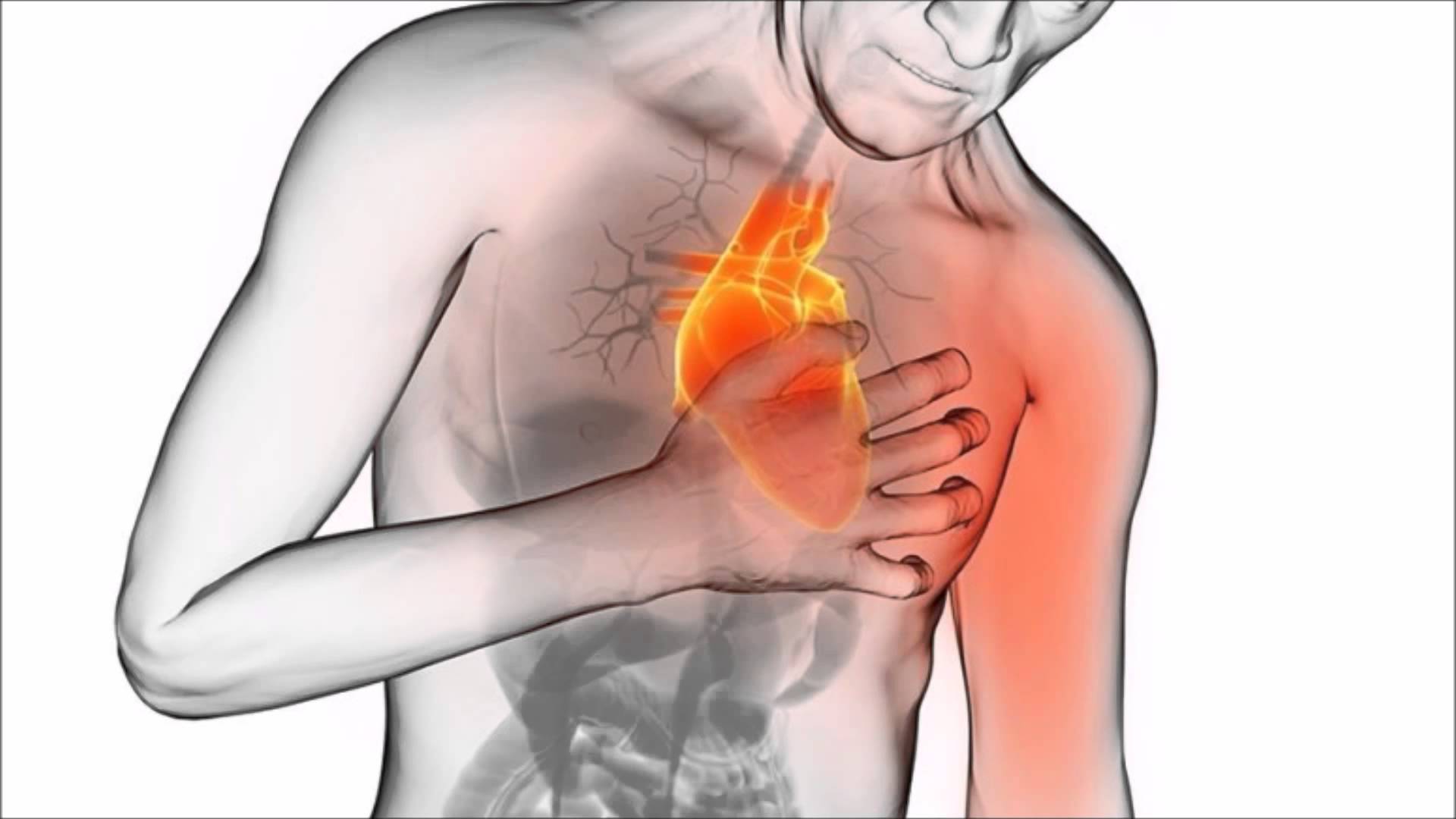 Infarto: factor de riesgo descubierto más alto que el colesterol