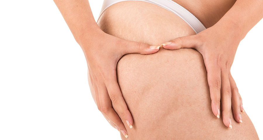 8 grandes mitos sobre la celulitis