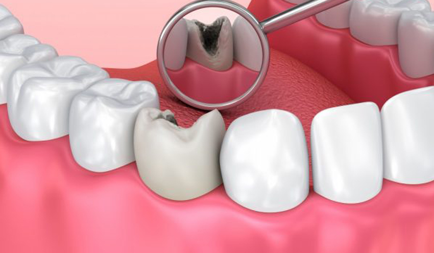 Caries dentales: causas, síntomas y tratamiento