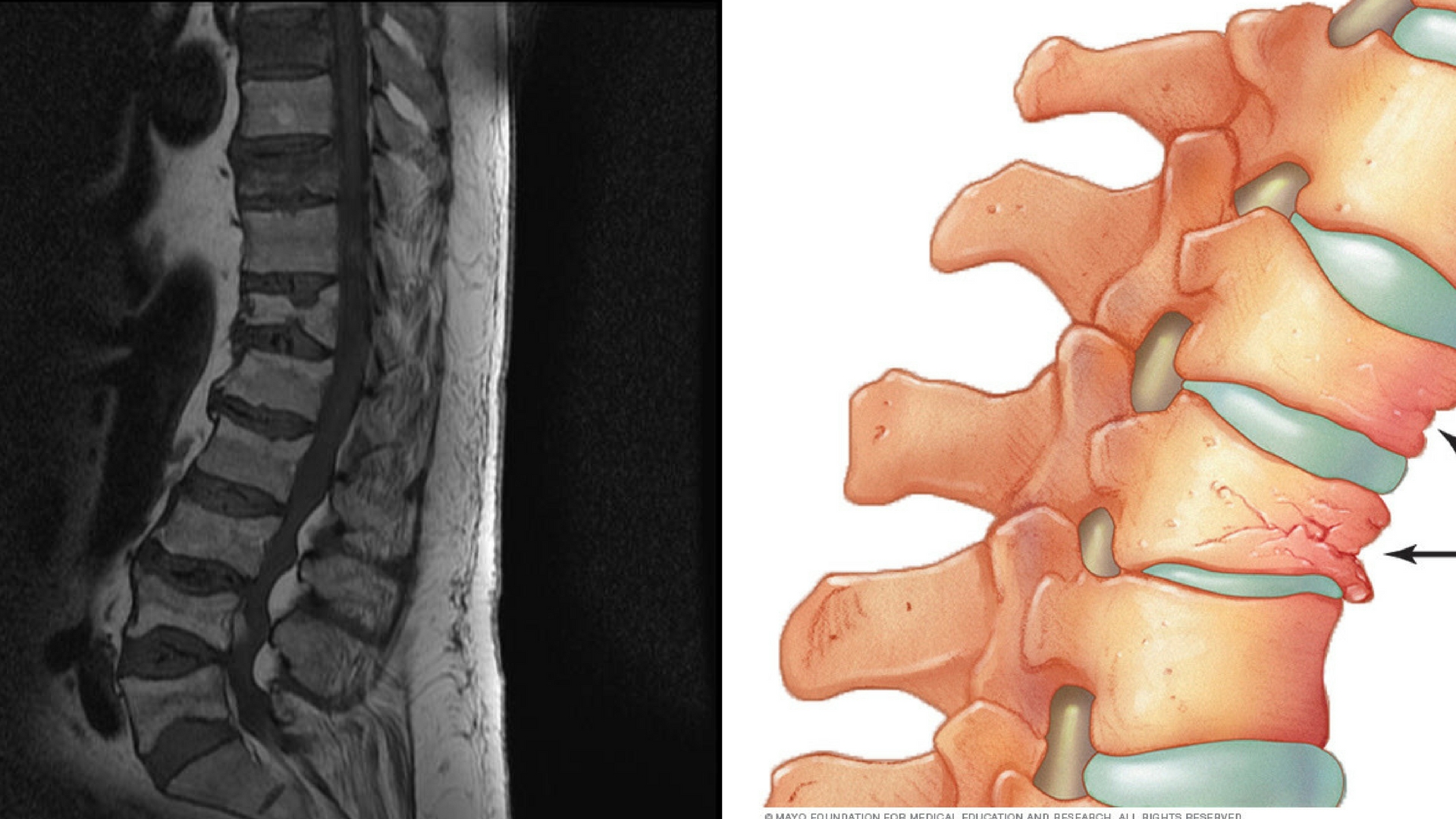 La osteoporosis? Es mejor prevenirlo como un niño