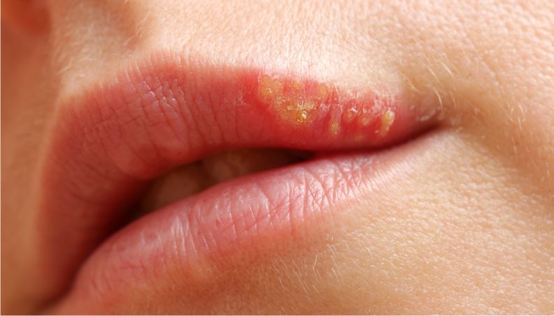 Protección y prevención del herpes