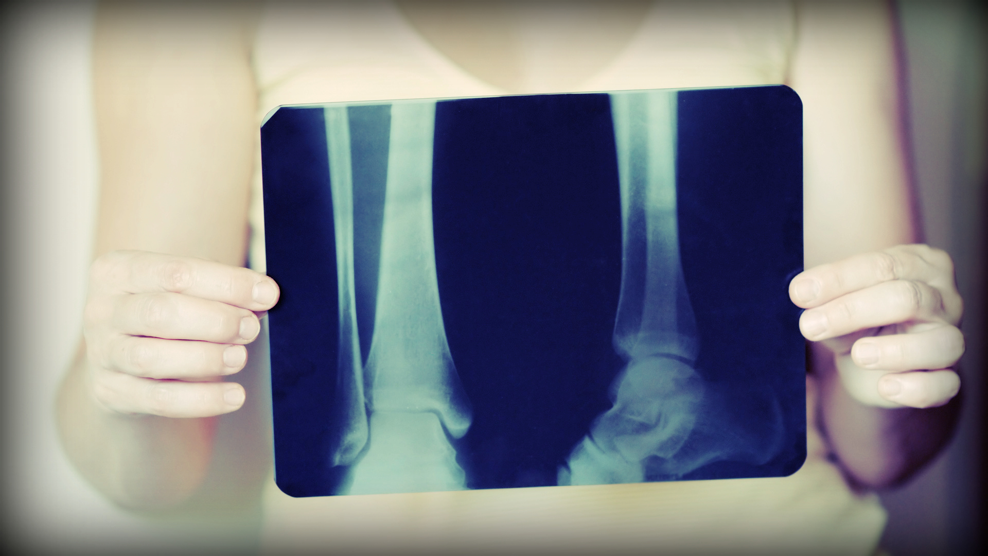 Osteoporosis, prevención con ciruelas pasas