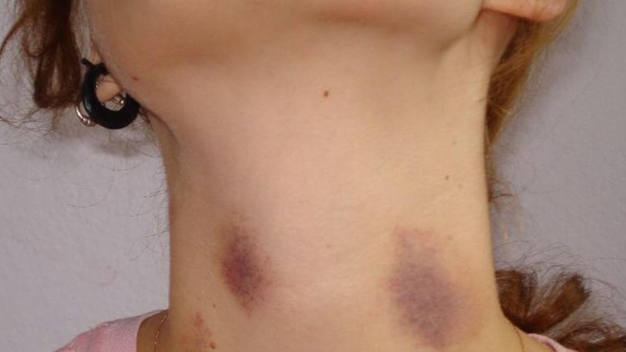 Marcas de amor? Veja como remover os 'chupões' em menos de 5 minutos, veja