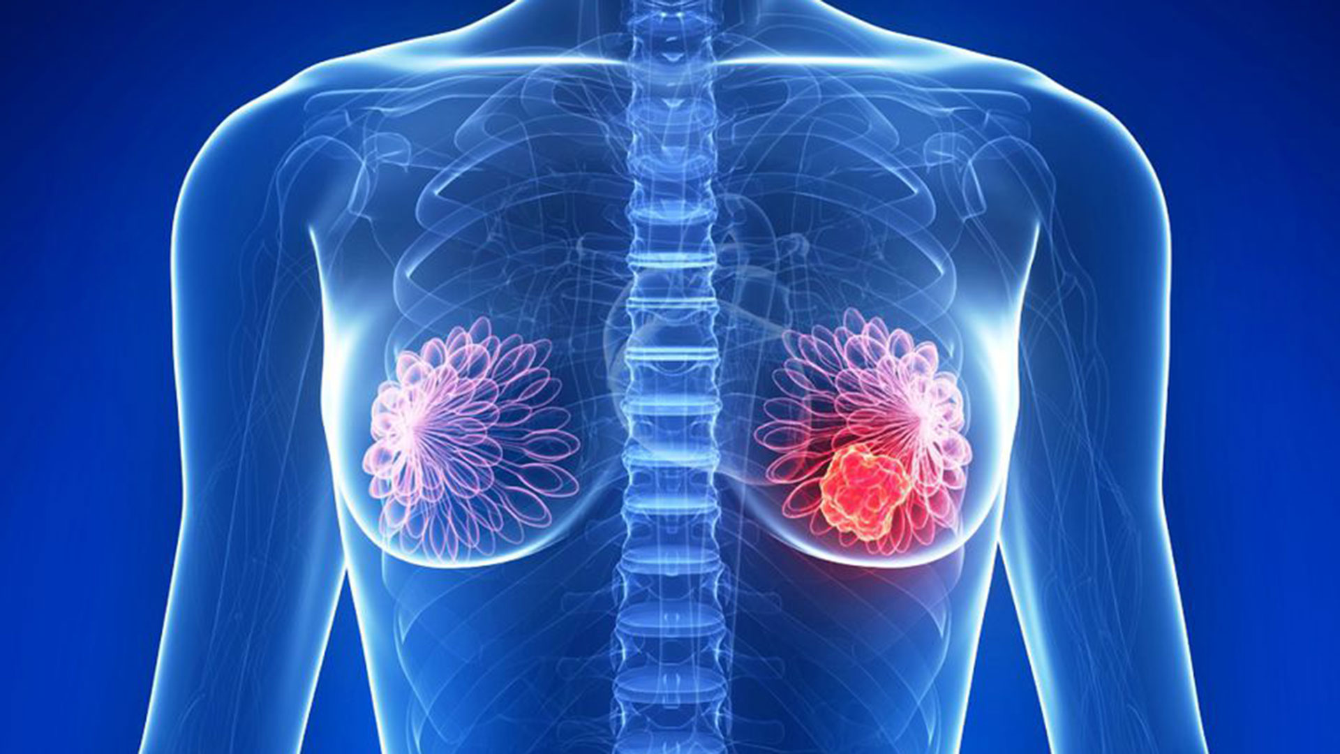 Cáncer de mama: lo que necesita saber para prevenirlo
