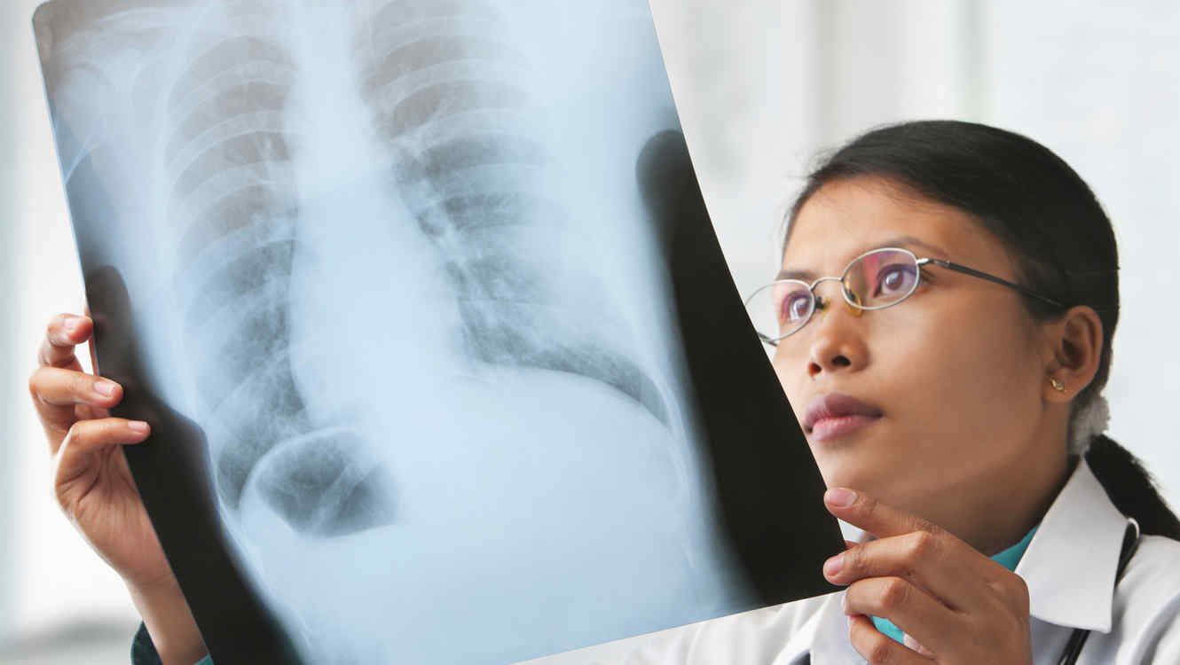La forma de detener el desarrollo del cáncer de pulmón ha sido descubierta