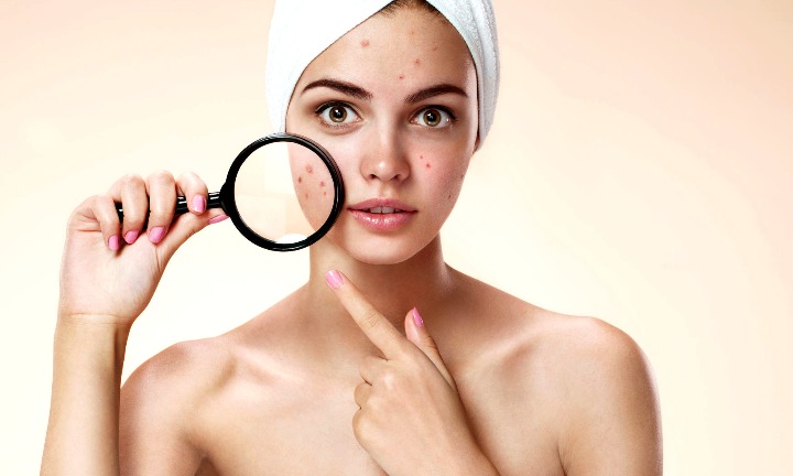 Aceite de jojoba: remedio natural contra el acné y las cicatrices