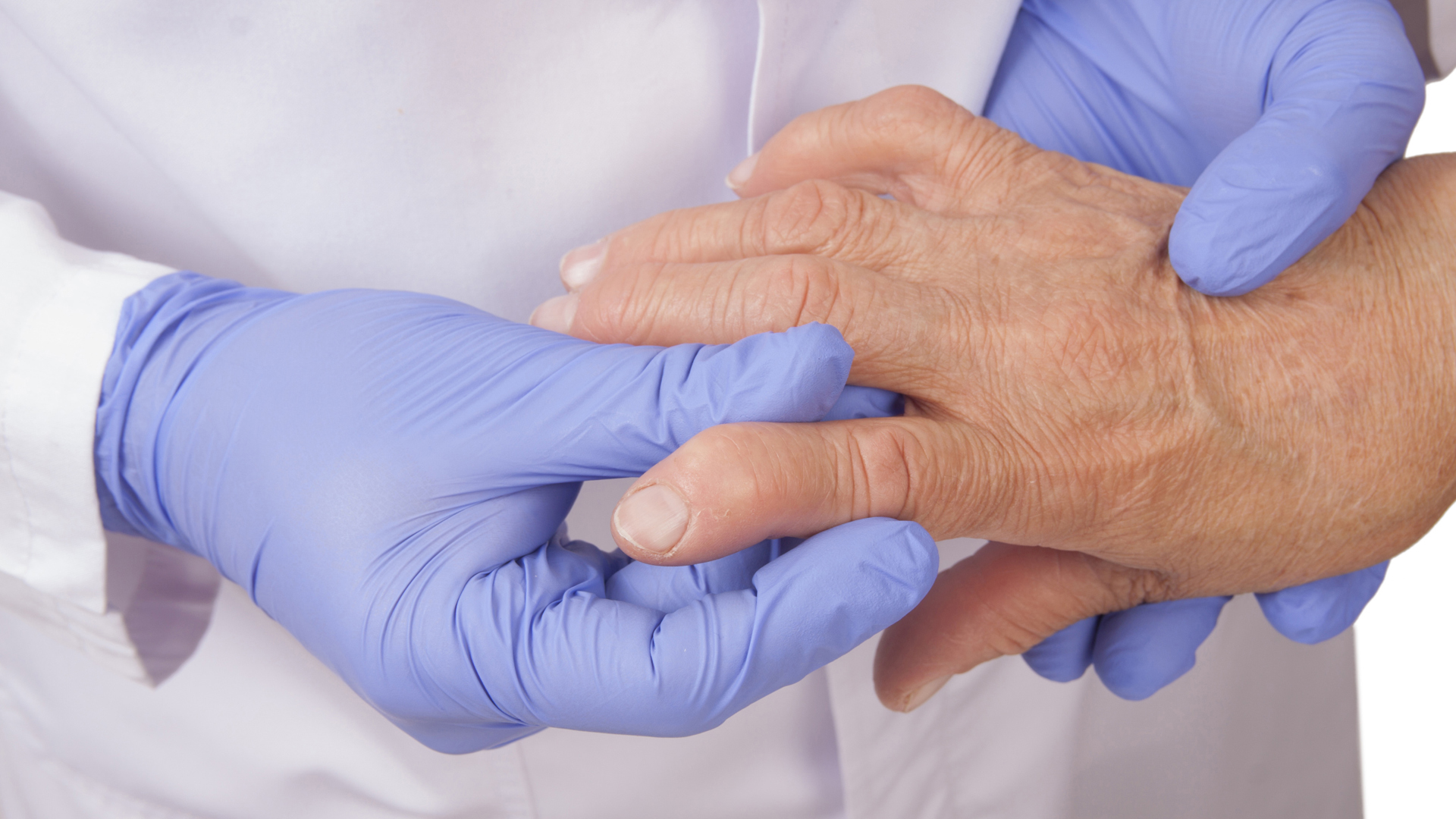 La FDA aprueba Sarilumab, una nueva droga biológica para la artritis reumatoide