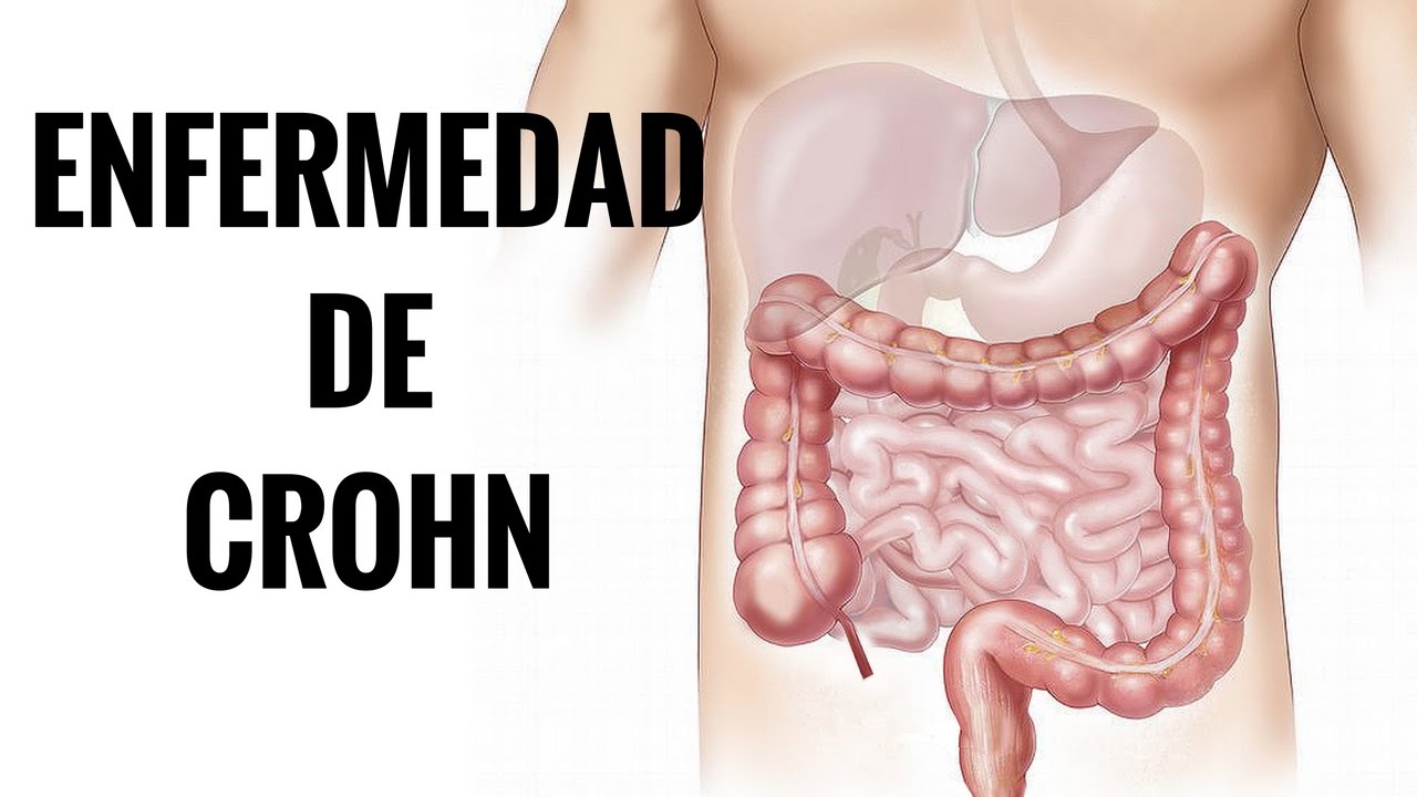 Electricidad para combatir la enfermedad de Chron