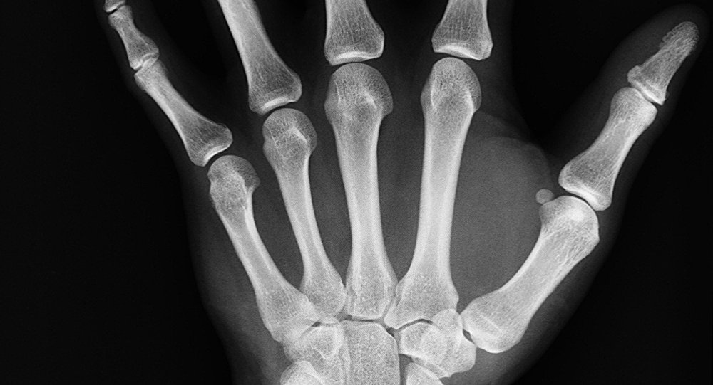 ¿Cuales son los síntomas del cáncer de hueso?