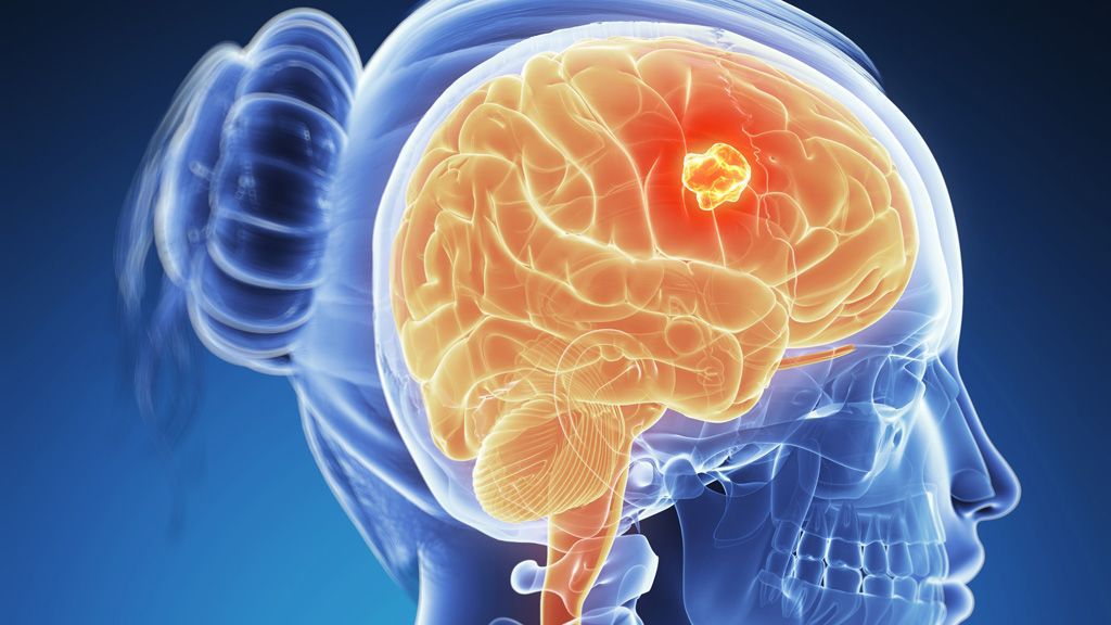 ¿Cuáles son los síntomas del tumor cerebral?
