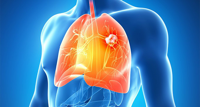 El cáncer de pulmón es alarmante: las mujeres son mas afectadas que los hombres