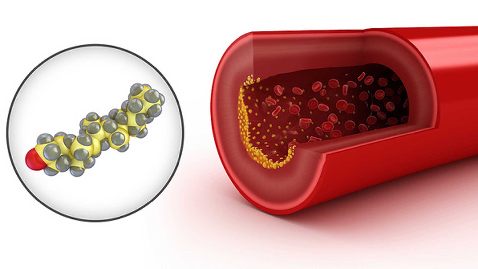 La vacuna contra el colesterol llega para prevenir enfermedades cardiovasculares