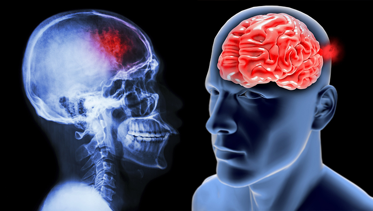 Los pacientes con accidente cerebrovascular experimentan problemas con el sueño