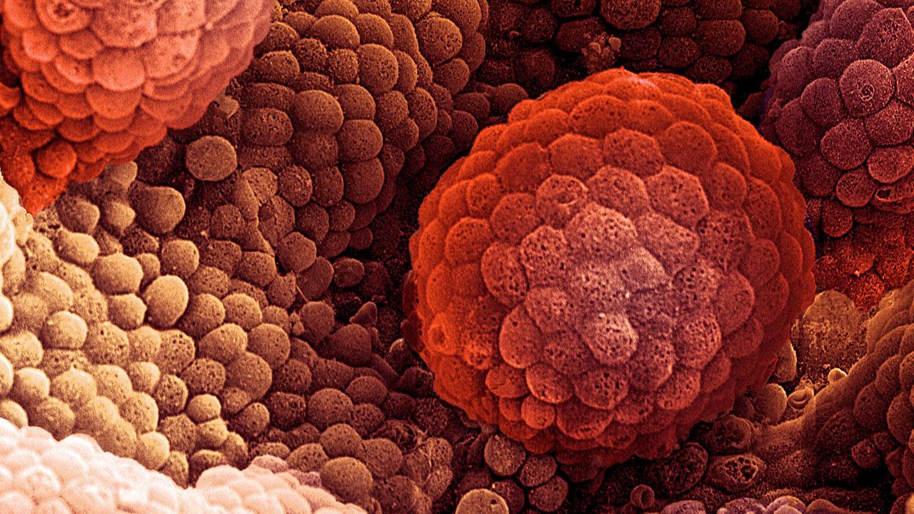 La aparición repentina de diabetes puede ser un síntoma de cáncer de páncreas