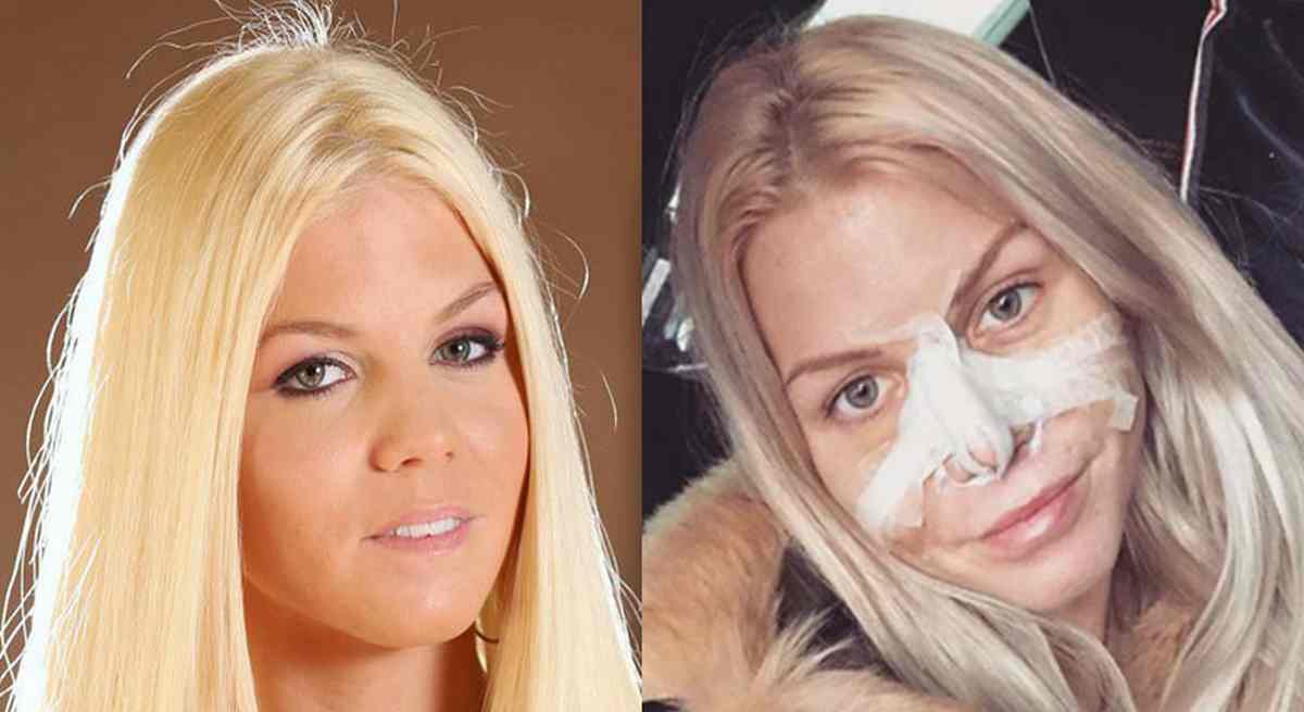 Jessica Thivenin (LMvsMonde3) va se faire opérer du menton