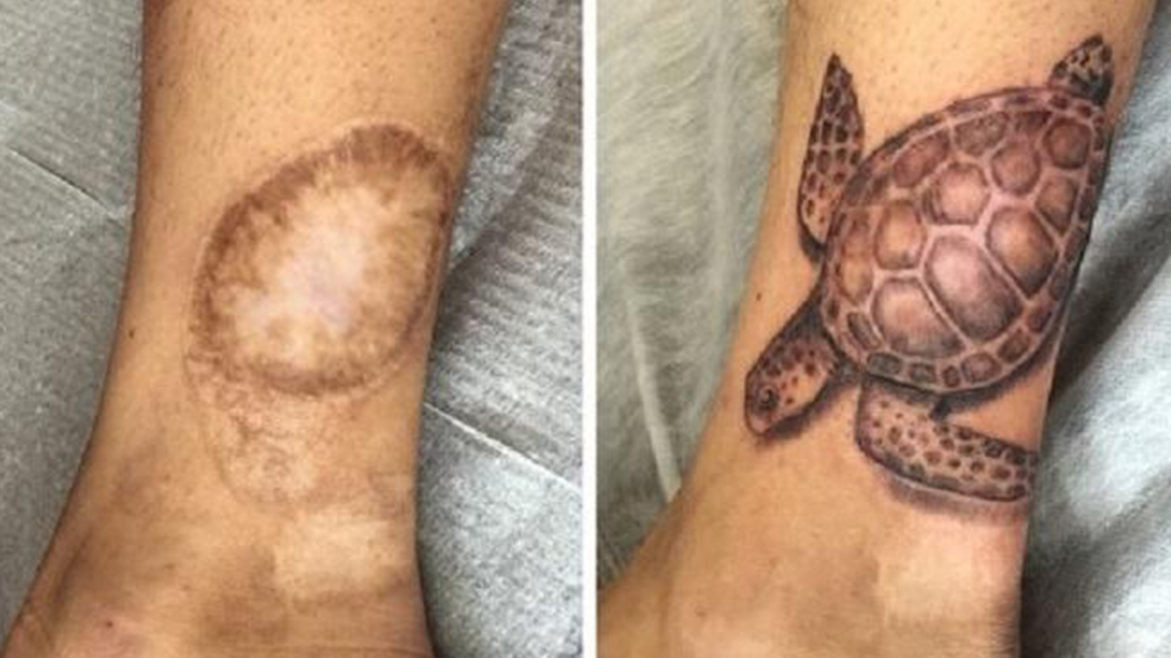 As tatuagens que ajudaram a livrar algumas pessoas de cicatrizes