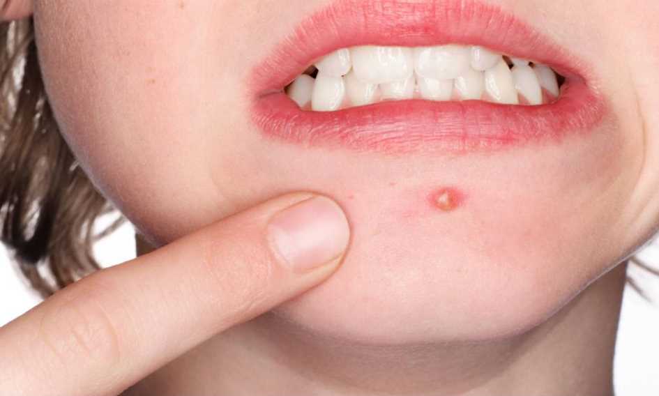 5 fatores que mais causam espinhas