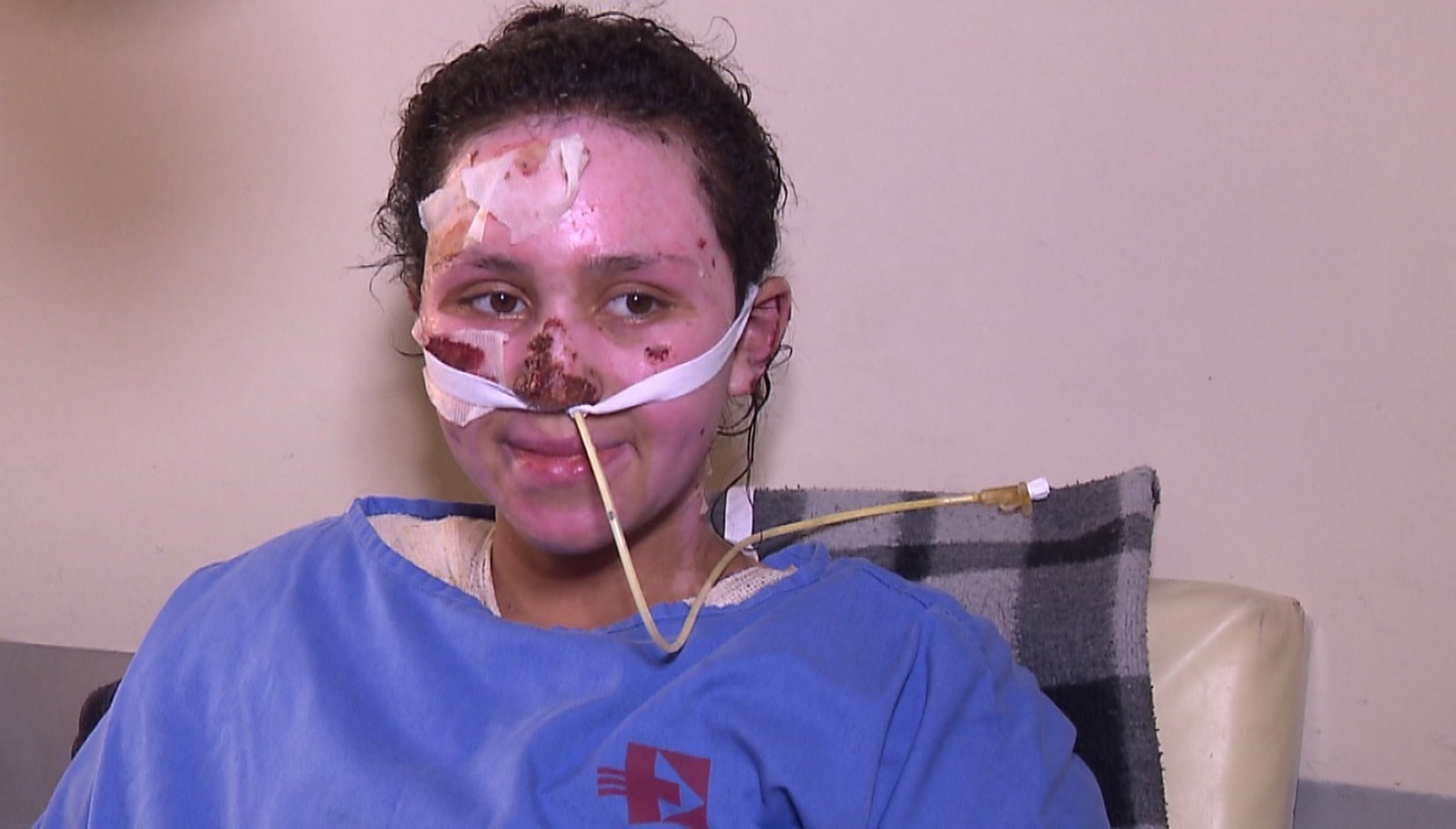 Morre adolescente que teve 60% do corpo queimado após incêndio