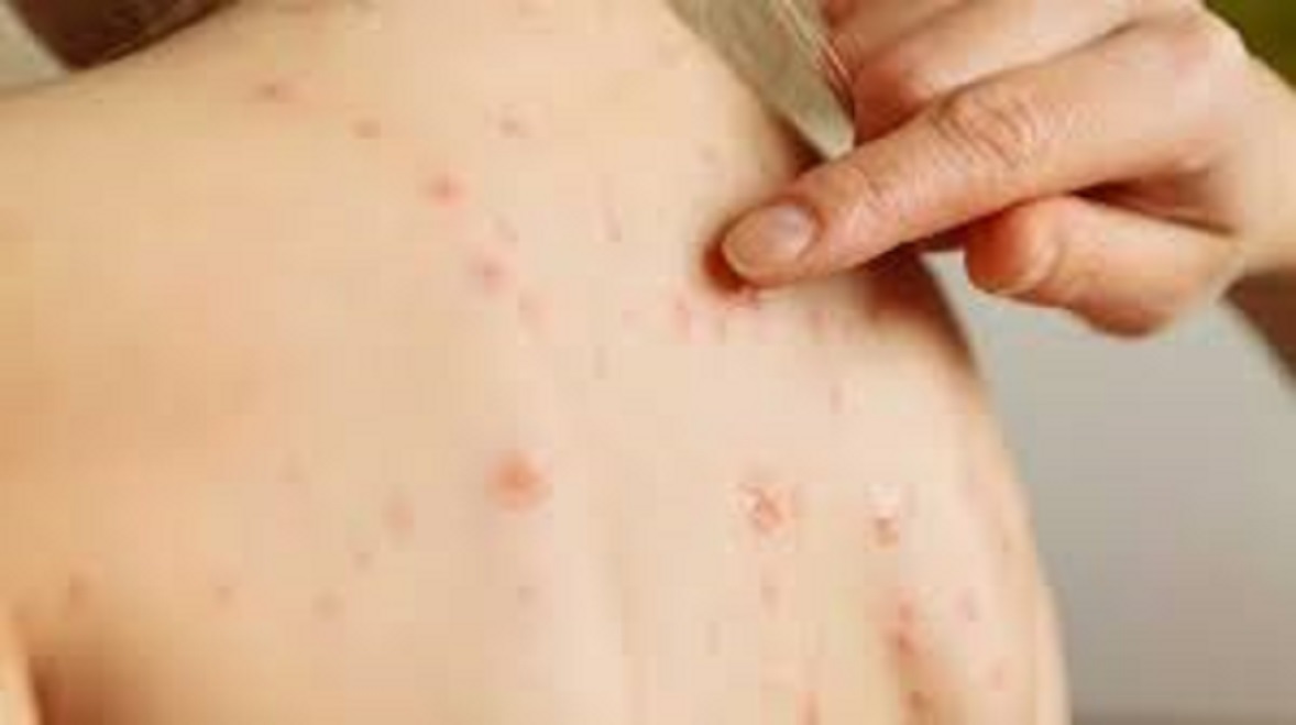 Il est possible de combattre la rougeole par la vaccination