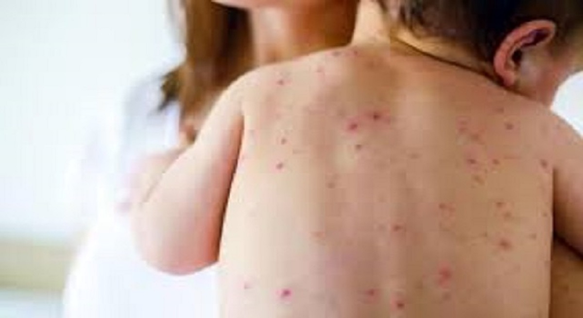 Epidemia de Sarampión enciende las alarmas en New York