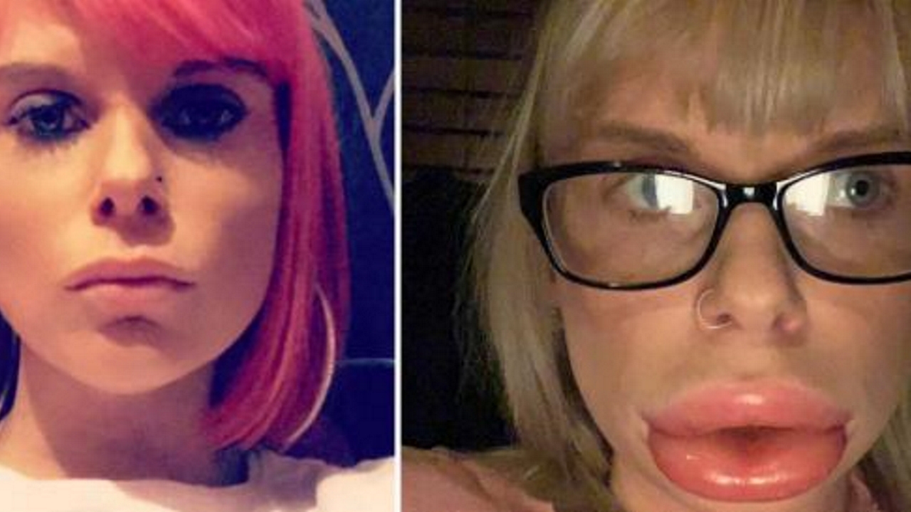 Une femme se retrouve avec des 'lèvres-saucisses' après l'usage d'un produit de beauté