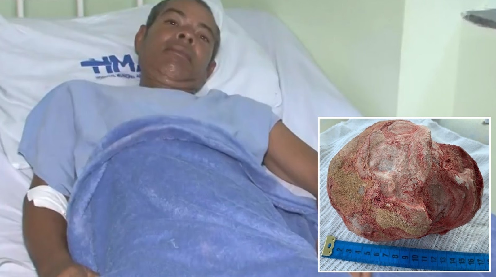 Homem retira pedra nos rins de 1,3 kg na Bahia