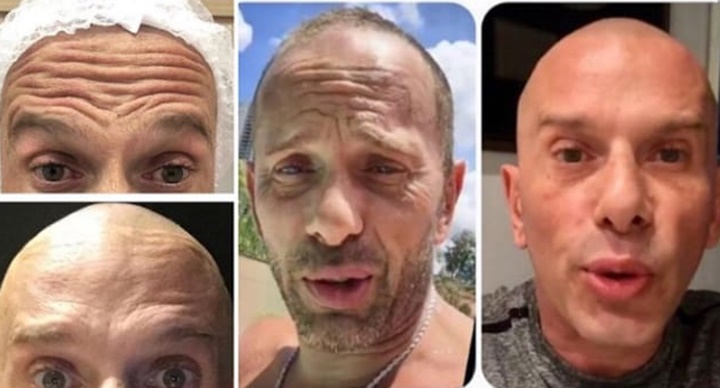 Rafael Ilha exibe antes e depois de procedimento de harmonização facial