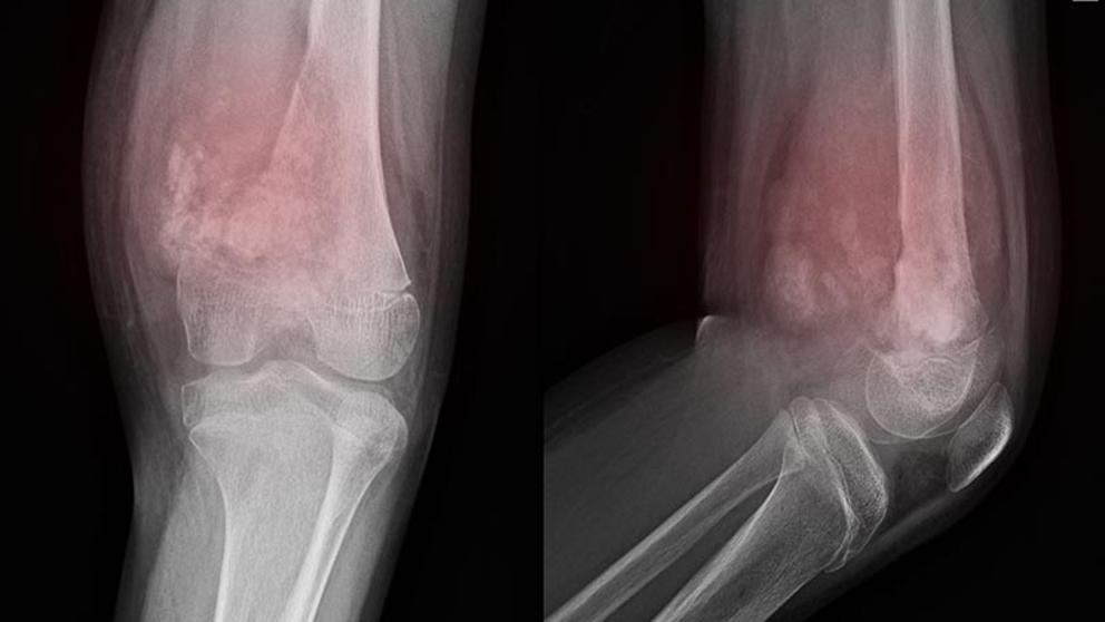 El osteosarcoma es una enfermedad muy poco común que afecta especialmente a los jóvenes